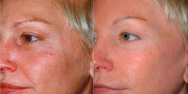 RedLuxe™ Therapy Mask – LED Facial & Neck Skin Renewal